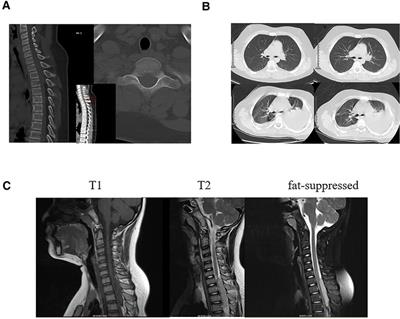 A case of giant Ewing's sarcoma (EES)/primitive neuroectodermal tumor (PNET) of the cervicothoracic junction in children with incomplete paralysis of both lower limbs: Case report and literature review